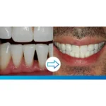 FILTEK SUPREME FLUIDO RESTORATIVE JERINGAS SOLVENTUM - Imagen 2